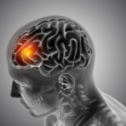 Hirntumor in Orange auf einer Grafik des Gehirns im Kopf