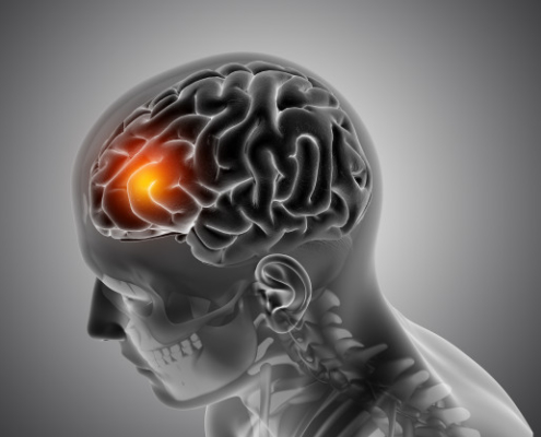Tumeur cérébrale en orange sur un graphique représentant un cerveau à l'intérieur d'une tête