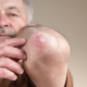Man pointing to his psoriasis elbow