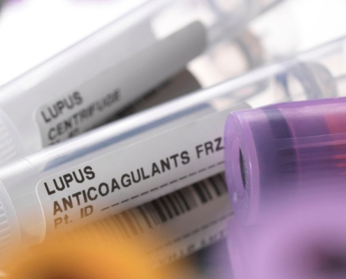 Lupus viral testing tubes