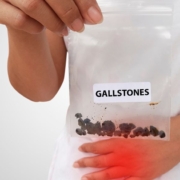 Person holding a bag of gallstones while holding his pelvis in pain