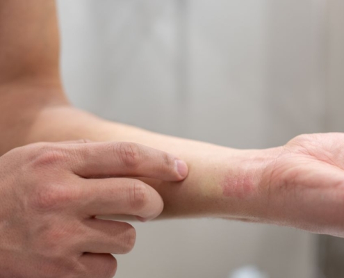 Man showing an allergic reaction on his wrist
