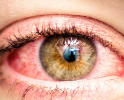 Close-up of infected eye