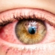 Close-up of infected eye
