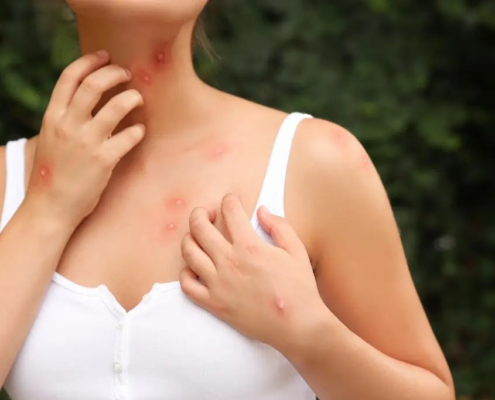 Woman itching her mosquito bites
