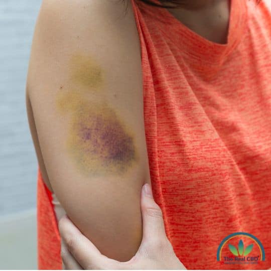 Gran hematoma en el brazo de una mujer