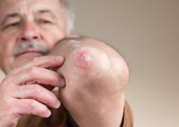 Man pointing to his psoriasis elbow