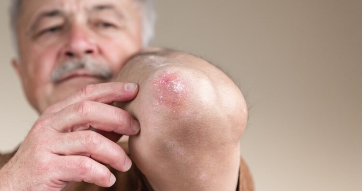 Man pointing to his psoriasis elbow