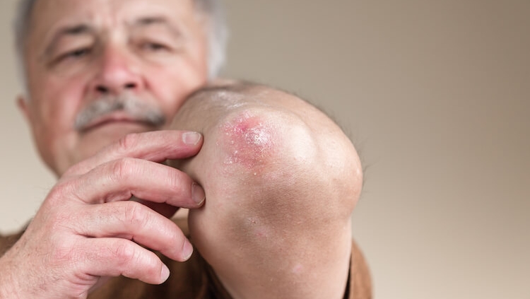 Man pointing to his psoriasis elbow