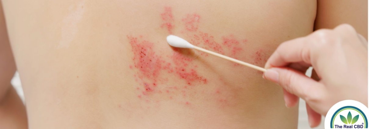 Cotton swap on shingles' breakout on skin of upper back