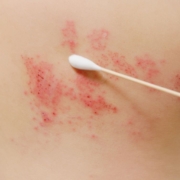 Cotton swap on shingles' breakout on skin of upper back