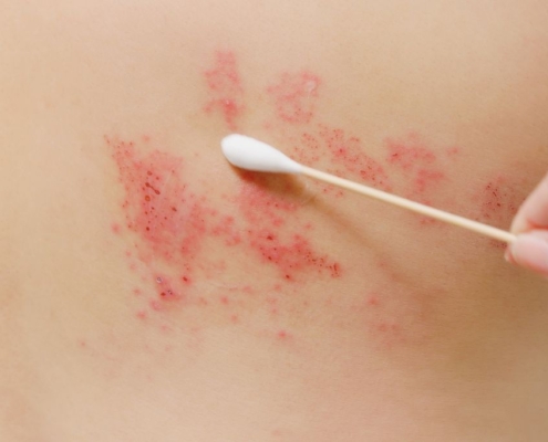 Cotton swap on shingles' breakout on skin of upper back