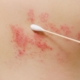 Cotton swap on shingles' breakout on skin of upper back