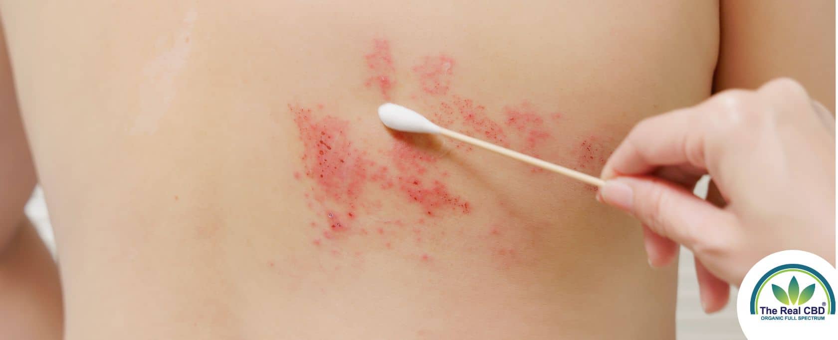 Cotton swap on shingles' breakout on skin of upper back