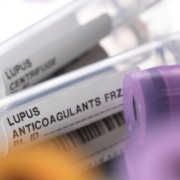 Lupus viral testing tubes