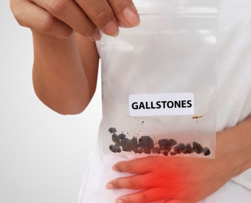 Person holding a bag of gallstones while holding his pelvis in pain