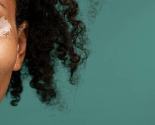 Coloured woman having vitiligo patches on her skin in the face