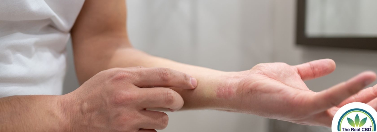 Man showing an allergic reaction on his wrist