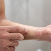 Man showing an allergic reaction on his wrist