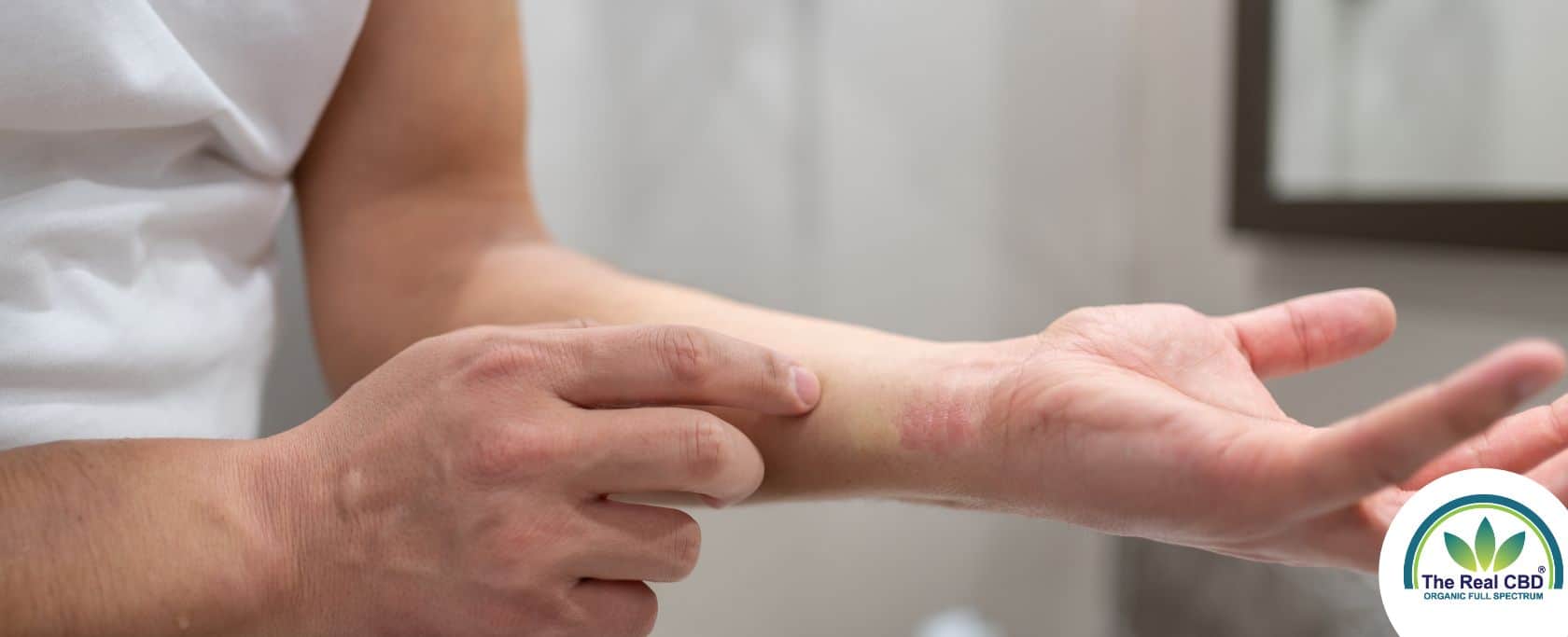 Man showing an allergic reaction on his wrist