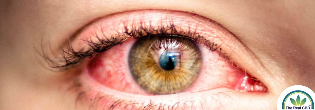 Close-up of infected eye