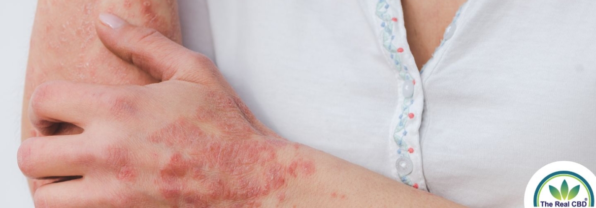 Woman scratching her psoriasis arm