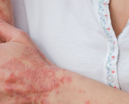 Femme se grattant le bras atteint de psoriasis