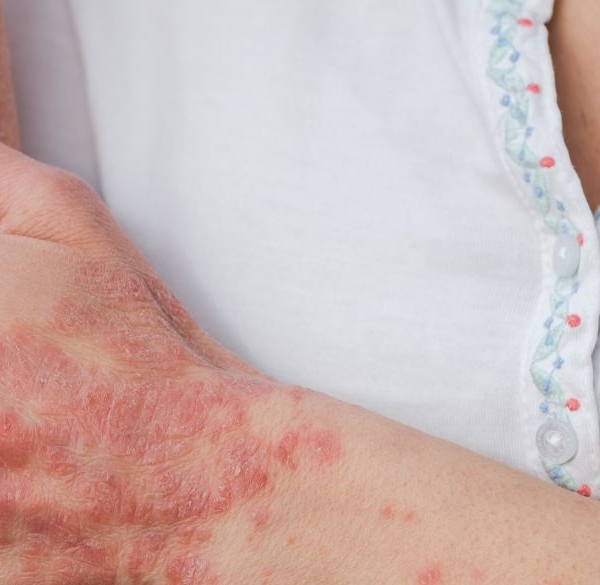 Woman scratching her psoriasis arm