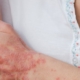 Woman scratching her psoriasis arm