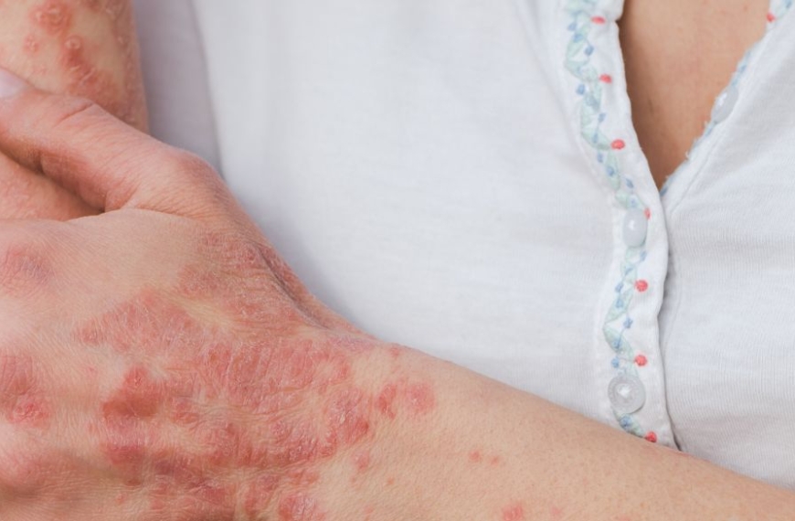 Femme se grattant le bras atteint de psoriasis