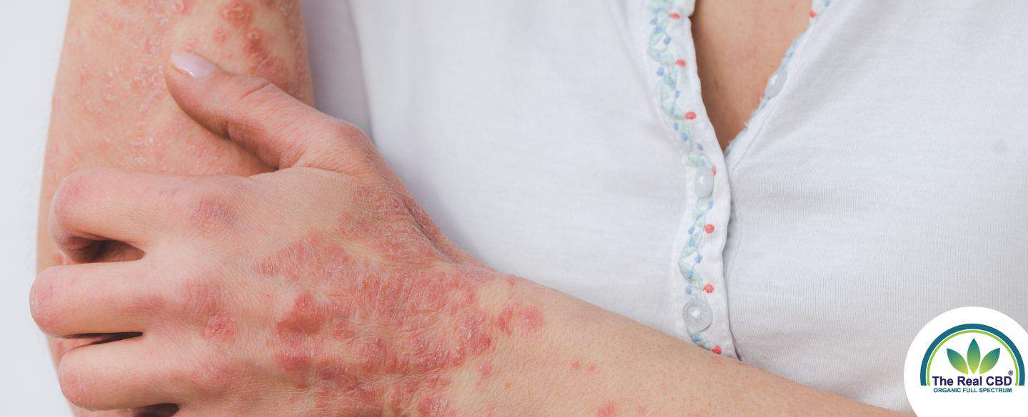 Woman scratching her psoriasis arm