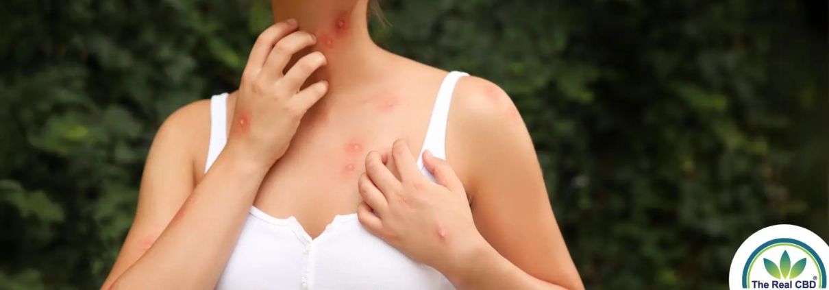 Woman itching her mosquito bites