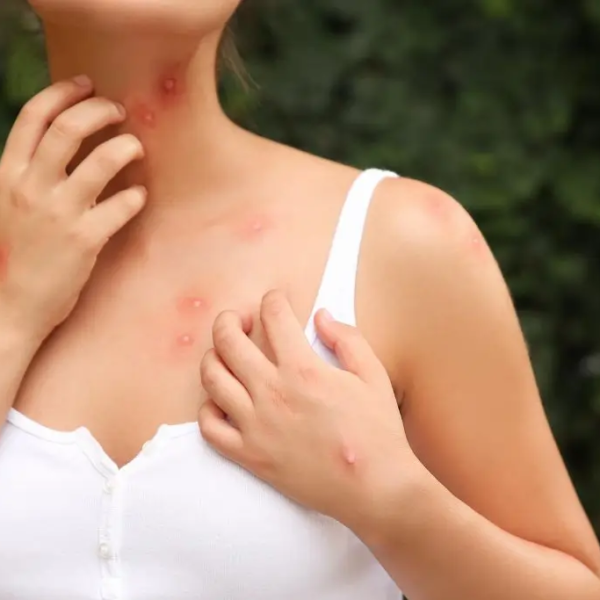 Woman itching her mosquito bites