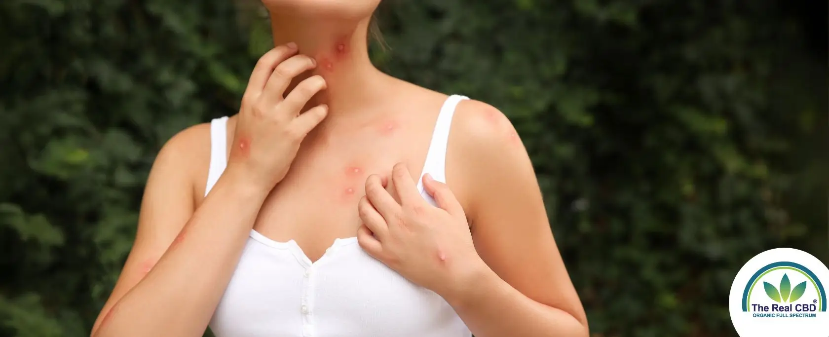 Woman itching her mosquito bites