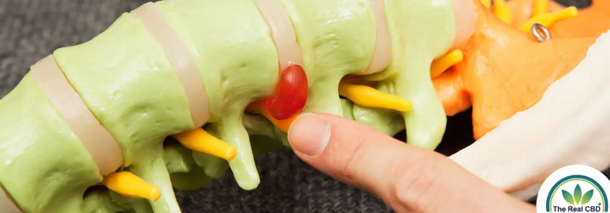 Finger pointing at a sample of a herniated disk