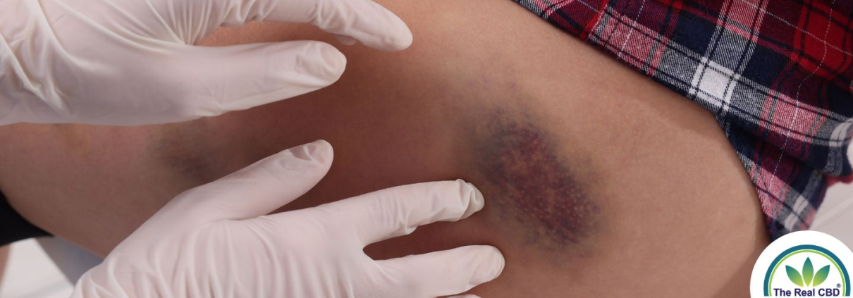 Doctors hands on a big bruise on woman's thigh