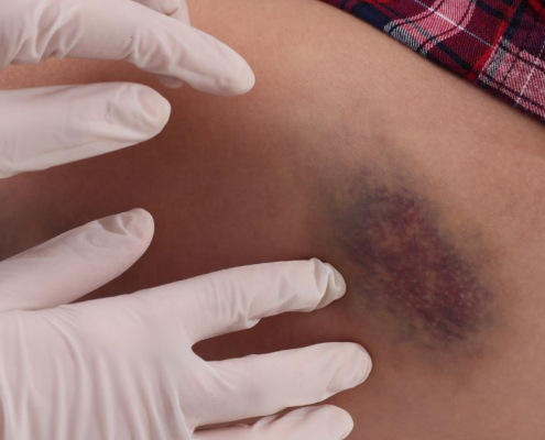 Doctors hands on a big bruise on woman's thigh