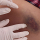 Doctors hands on a big bruise on woman's thigh