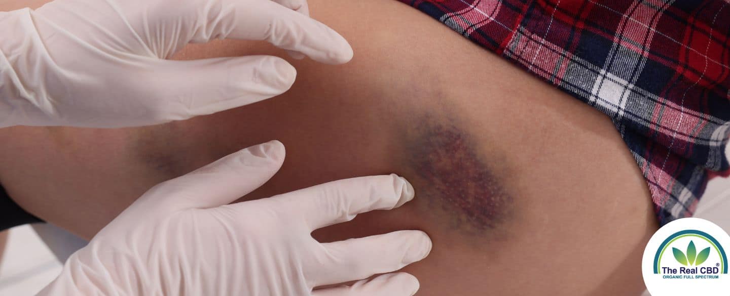 Doctors hands on a big bruise on woman's thigh