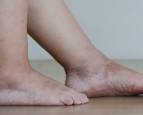 Jambes et pieds gonflés