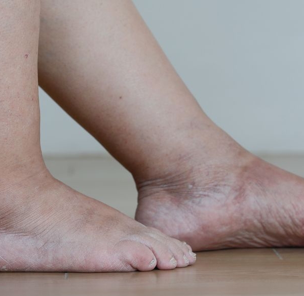 Jambes et pieds gonflés