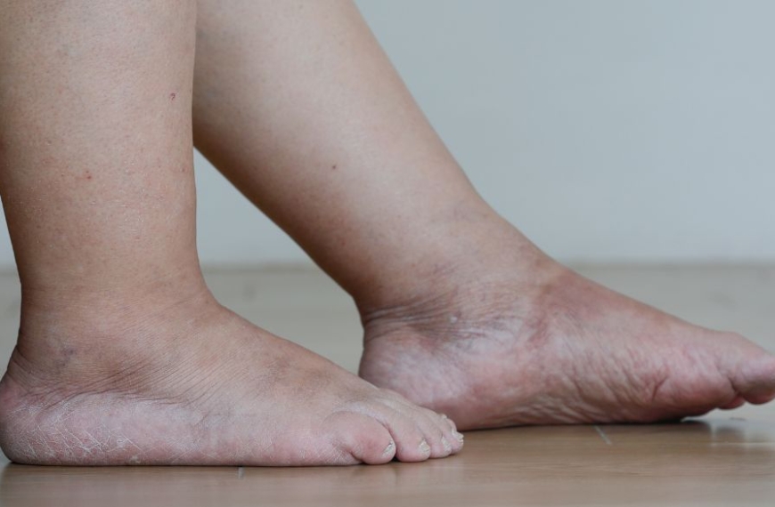 Jambes et pieds gonflés